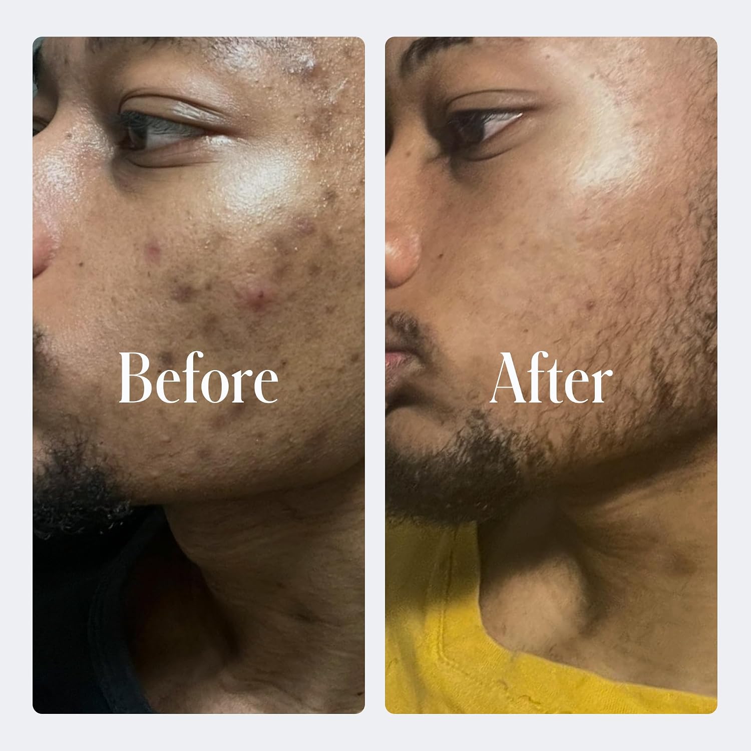 Geologie Complete Skincare Set for Men & Women | 3-Month Simple & Effective Daily Clear Skin Routine | Acne, Oily Skin, Dark Spots | Face Wash 2-Pack, Retinol Face Cream, SPF15 Moisturizer & Eye Cream