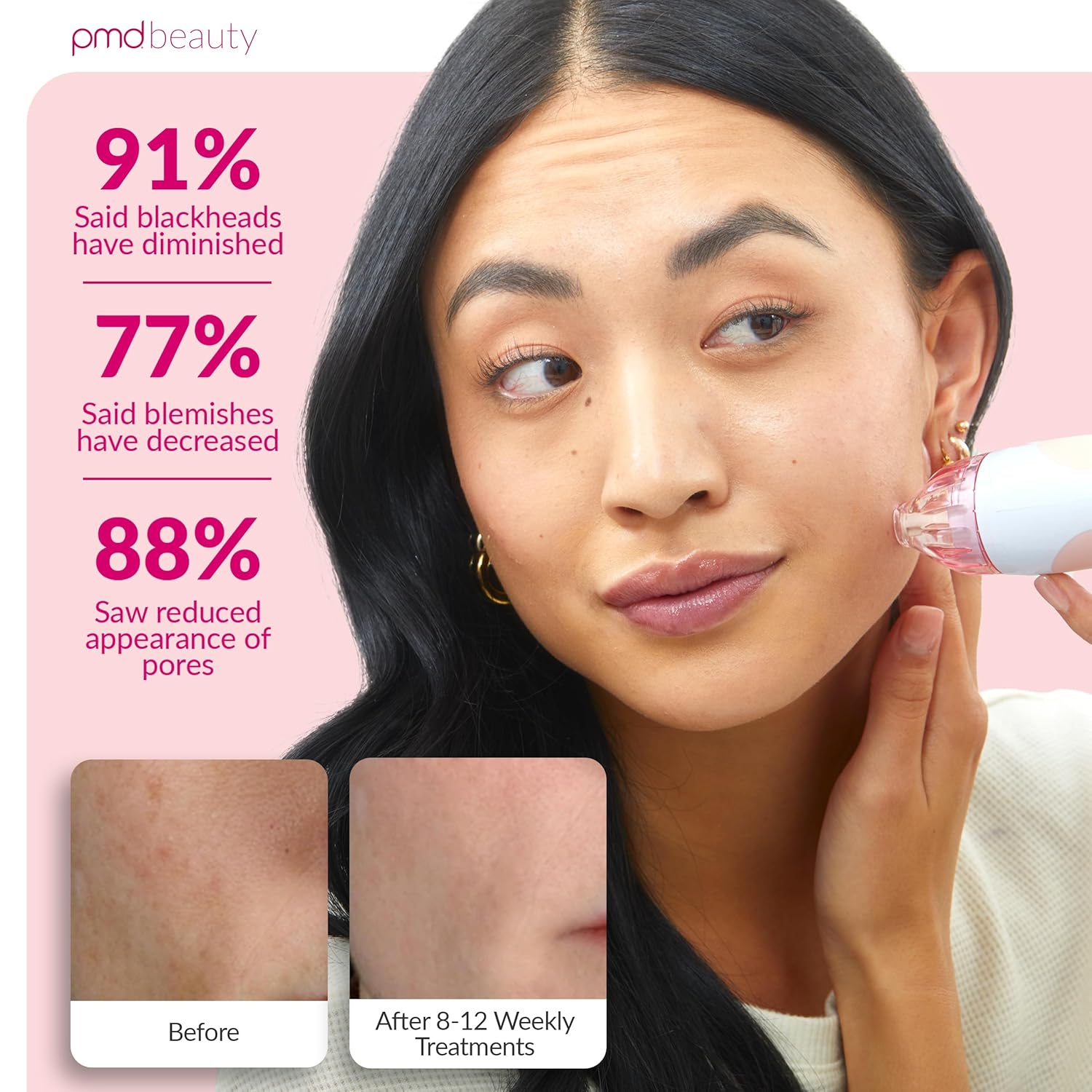 PMD Beauty Personal Microderm Classic - At-Home Use, Facial Exfoliator Tool, Microdermabrasion Machine Kit for Face and Body Skincare