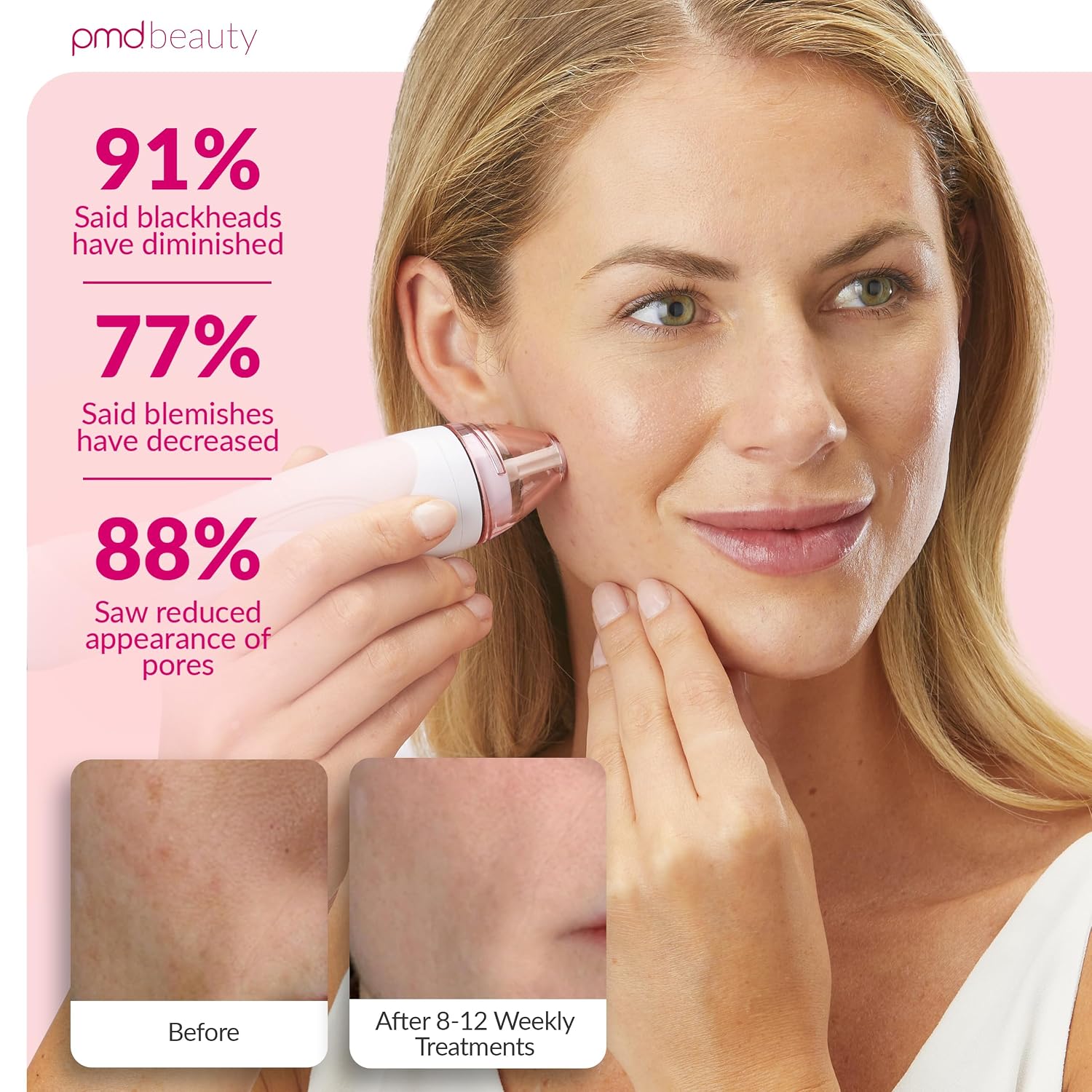 PMD Beauty Personal Microderm Pro - At-Home Use, Facial Exfoliator Tool, Microdermabrasion Machine Kit for Face and Body Skincare