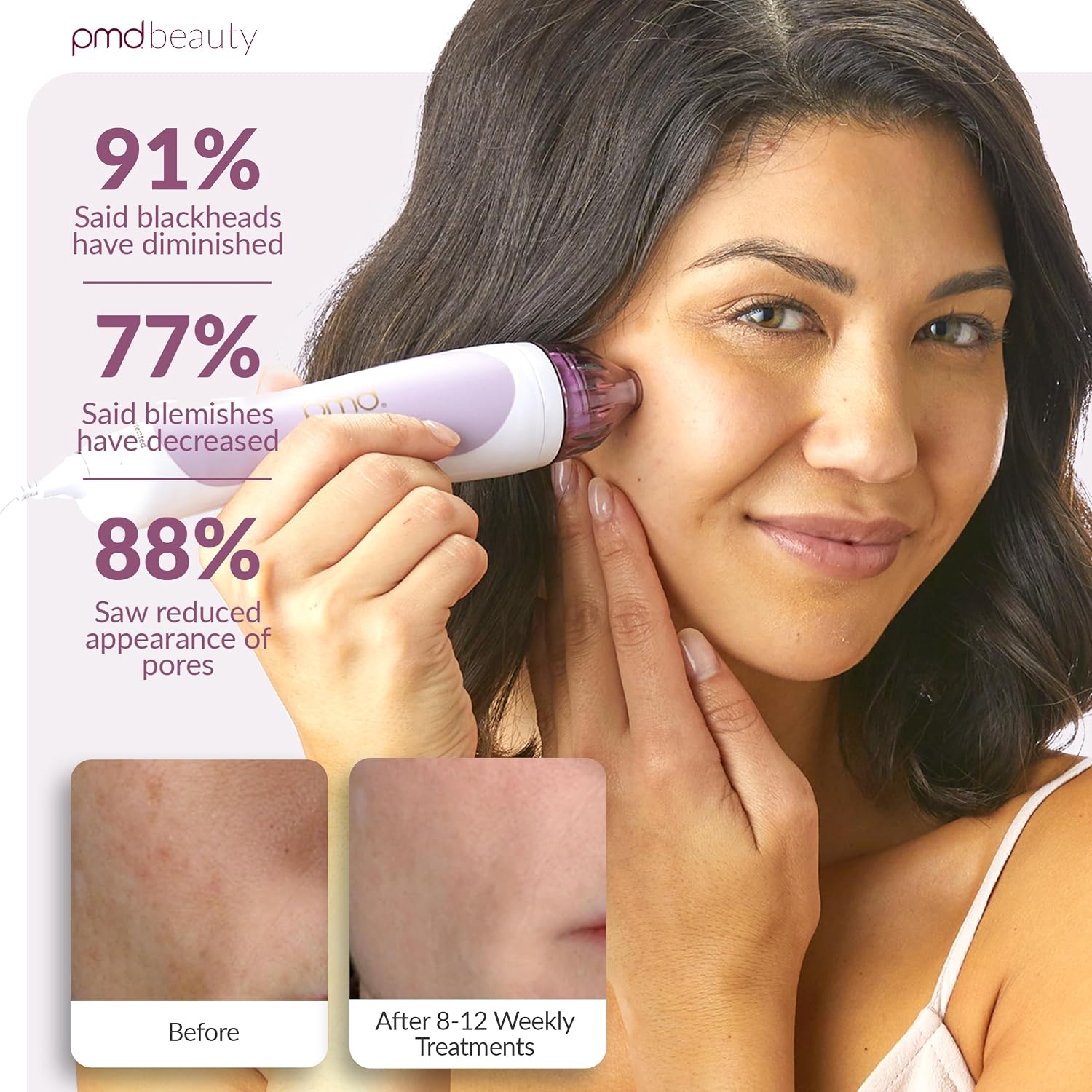 PMD Beauty Personal Microderm Classic - At-Home Use, Facial Exfoliator Tool, Microdermabrasion Machine Kit for Face and Body Skincare