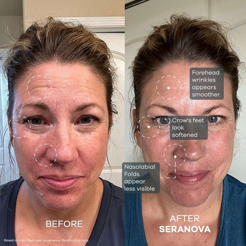 Seranova Micro Infusion System for Face & Neck 0.05mm Stamp with Hyaluronic Acid & Collagen Peptide Serum for Firmer Smoother-Looking Skin, Easy 5-Minute At-Home Skin Care Application - 2 Month Supply