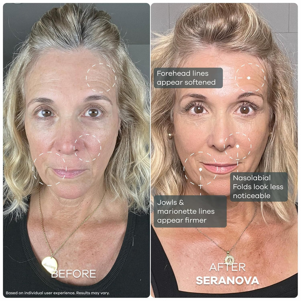 Seranova Micro Infusion System for Face & Neck 0.05mm Stamp with Hyaluronic Acid & Collagen Peptide Serum for Firmer Smoother-Looking Skin, Easy 5-Minute At-Home Skin Care Application - 3 Month Supply