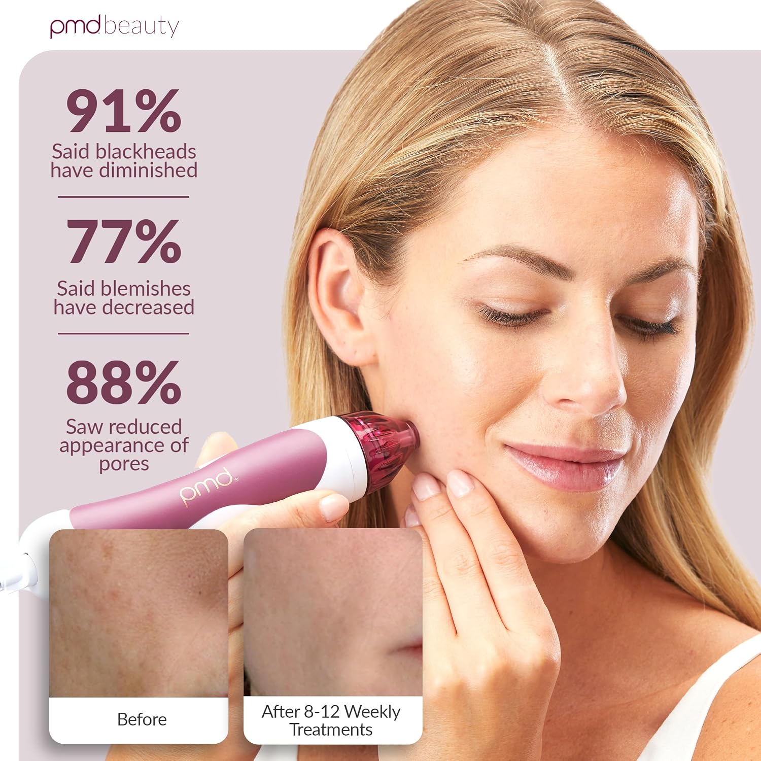 PMD Beauty Personal Microderm Classic - At-Home Use, Facial Exfoliator Tool, Microdermabrasion Machine Kit for Face and Body Skincare